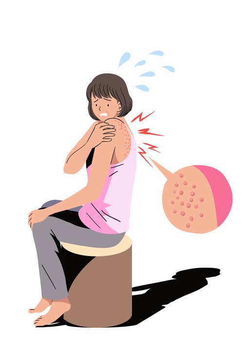 화끈거리는 통증에 물집까지, 50대 넘으면 대상포진 조심해야